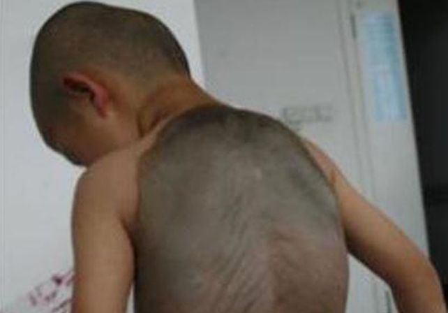 Conocé la historia del niño tortuga que asombra al mundo