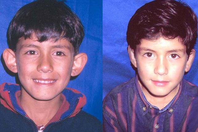 Otoplastia. Se trata de una intervención bastante común y para nada riesgosa en niños que reciben burlas en el ámbito escolar o entre sus amigos