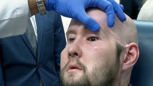 El doctor Eduardo Rodríguez comprueba el buen flujo sanguíneo y la falta de rechazo en el nuevo ojo de James.