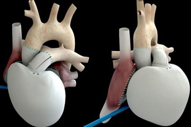 Trasplantan el primer corazón artificial autónomo en Francia