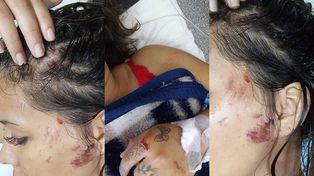 La víctima. Kiara Muñoz, de 20 años, sufrió traumatismo de cráneo y escoriaciones, y permaneció internada.