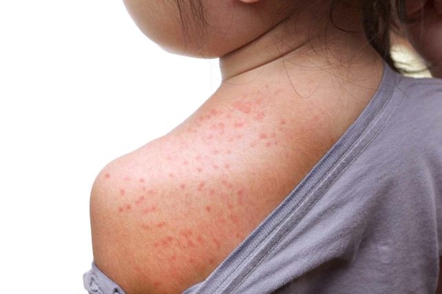 Alerta sarampión: puede haber un brote por las bajas tasas de vacunación