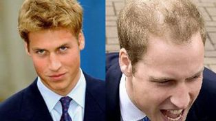 El pr&iacute;ncipe William preocupa a la corona brit&aacute;nica por su avanzada calvicie