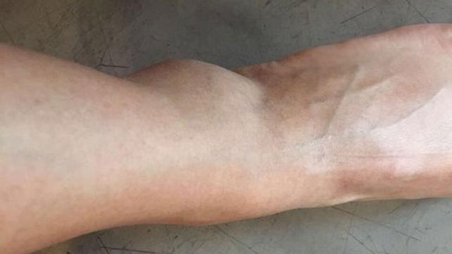 Se lesionó Barbie Vélez