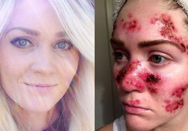 Tiene cáncer de piel por la cama solar y lo mostró con una selfie impactante