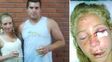 Una chica denunció que su novio le desfiguró el rostro por cómo bailaba