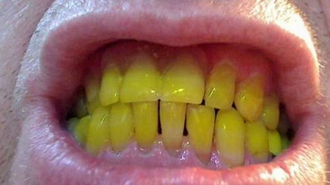 El nuevo truco para blanquear los dientes ya es furor en todo el mundo