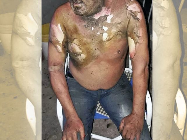 Encendió un cigarrillo, se le prendió fuego la remera y sufrió graves quemaduras
