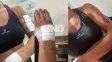 Otro salvaje ataque de un perro pitbull, ahora en Rincón: una mujer salió a correr y fue mordida por el animal