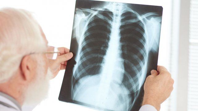 Cáncer de Pulmón: Lalcec San José organiza charla gratuita