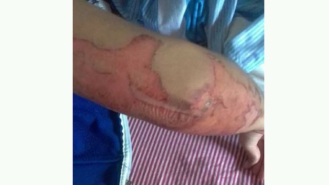 Un boxeador roció con nafta y prendió fuego a su novia
