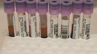 Otro voluntario de la vacuna de AstraZeneca registra un trastorno neurológico 