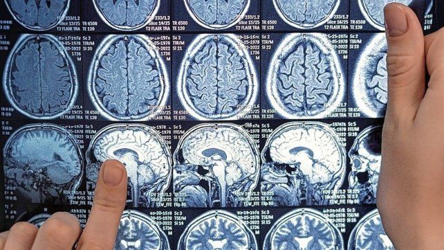 El hallazgo permitirá avanzar en futuros tratamientos terapéuticos contra la esclerosis múltiple