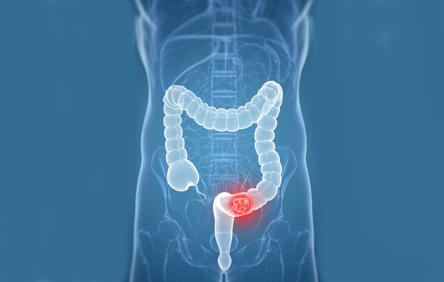 Distribuirán test para la detección temprana de cáncer de colon y recto