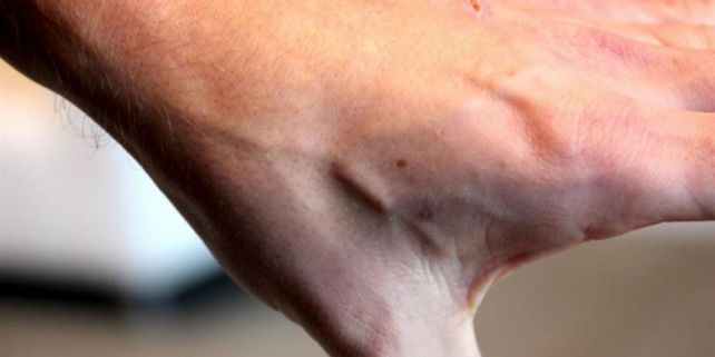 Polémico. Los implantes dejan una pequeña protuberancia en la piel.