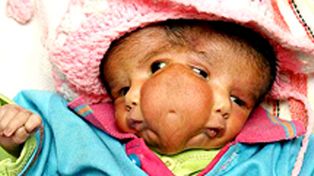 Una beba con dos caras es adorada en la India