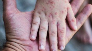 Confirman el primer caso de sarampión en Entre Ríos