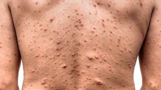 Confirmaron un brote de varicela en Entre Ríos