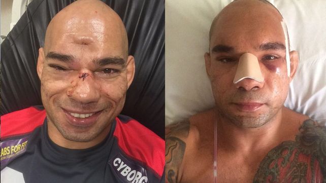 Así le quedó el cráneo al luchador que había sufrido una fractura en un combate