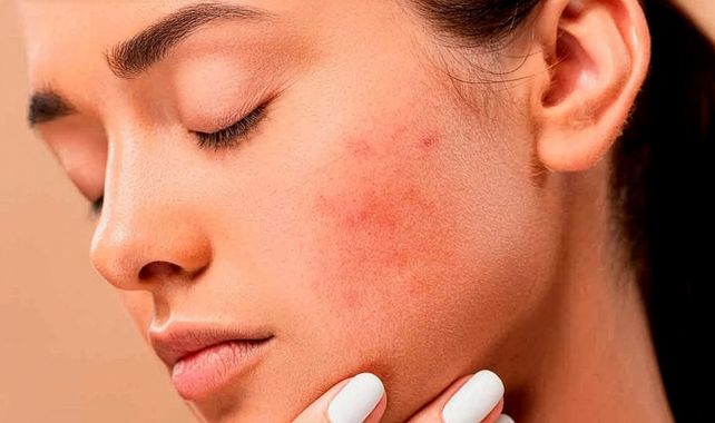 Dermatitis atópica: una enfermedad crónica que afecta la piel y la calidad de vida