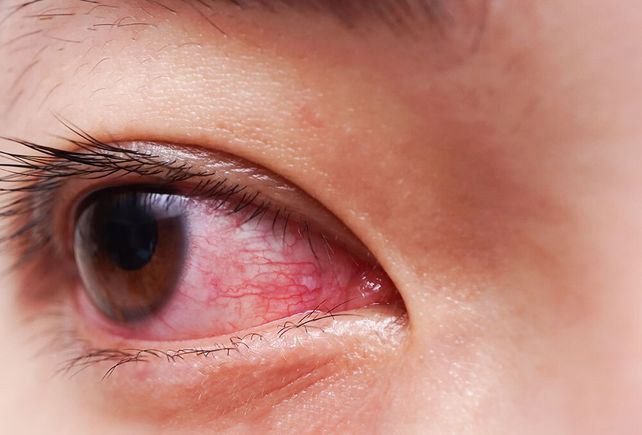 Ojos rojos