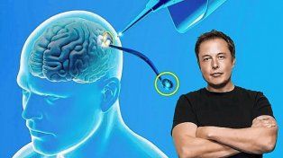 El chip de Elon Musk podría posibilitar restaurar la visión incluso de pacientes que nunca la tuvieron