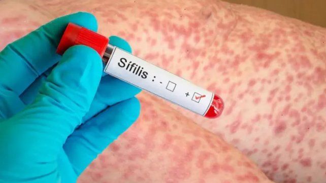 Entre Ríos registró 1.029 casos de sífilis en 2025.