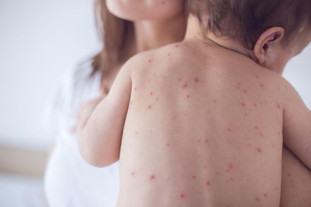 Los niños de menos de un año son más proclives a sufrir complicaciones graves. Es vital vacunar a partir de los 12 meses.