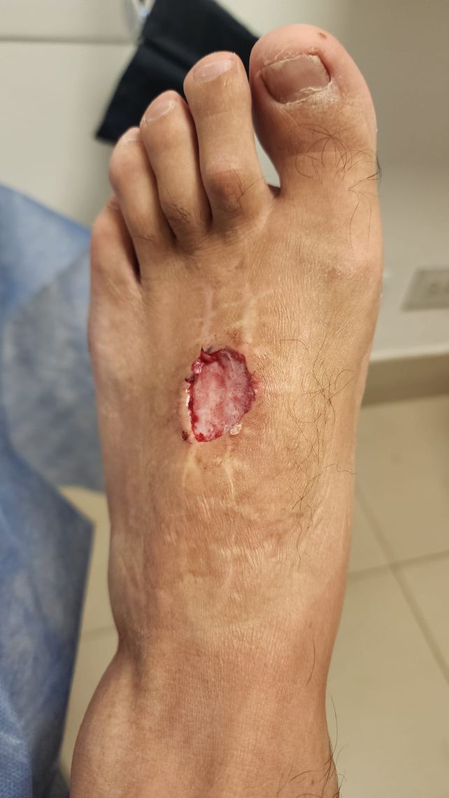 Herida. Los ataques pueden provocar lo que se conoce como un sacabocado