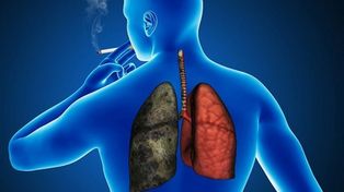Avances en terapias dirigidas contrael cáncer de pulmón y el de vejiga