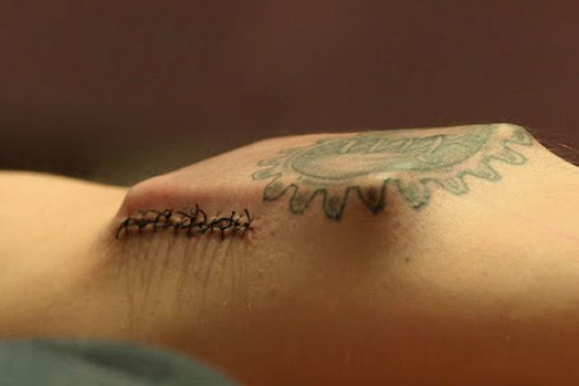 Se implantó una mini PC en el brazo para vivir cientos de años