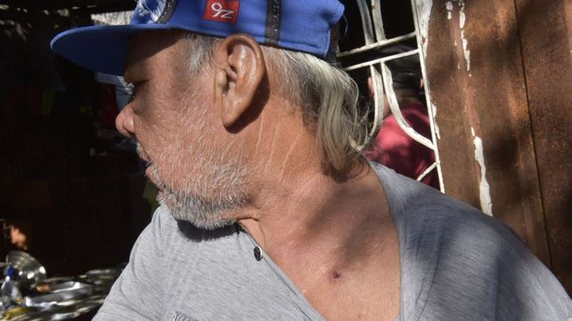 Un vecino mostró la herida que le dejó una bala que le rebotó abajo del cuello.