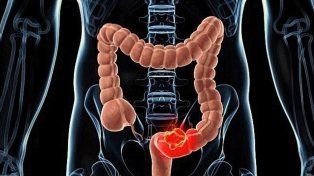 Un nuevo tratamiento contra el cáncer de colon, por científicos del Conicet y la Fundación Instituto Leloir