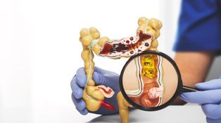 Cáncer colorrectal: la ventana de diez años que permite neutralizarlo antes de que aparezca