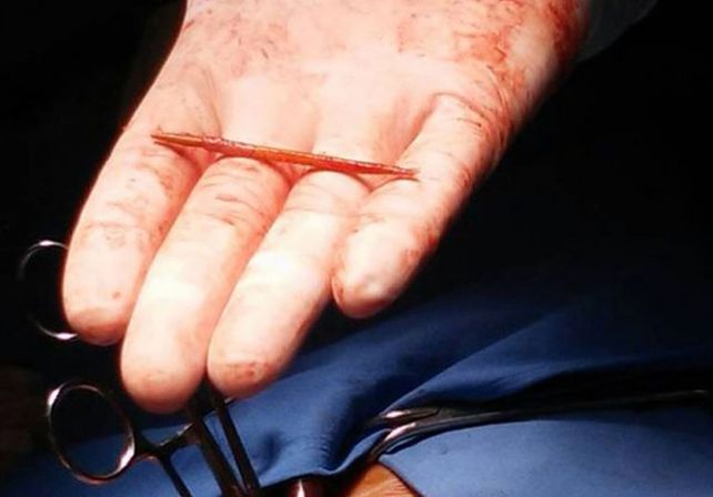 Un caso único: le extrajeron un escarbadientes del corazón