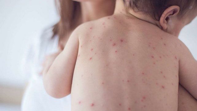 Desde el lunes se podrán vacunar niños contra el sarampión y la rubeola