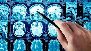 ACV: Los factores de riesgo son similares a los de un infarto