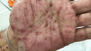 En 2024 Entre Ríos reportó 467 casos de sífilis. Este año se notificaron 811. En tanto bajaron los casos de tuberculosis. Los datos de tos convulsa y dengue