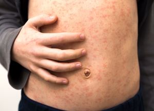 Sarampión: una enfermedad que vuelve a preocupar