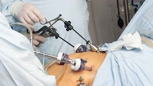 El bypass gástrico para bajar de peso también logra combatir la diabetes tipo 2