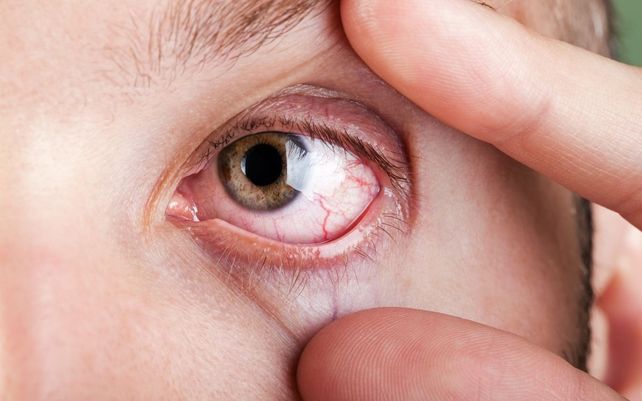 Un problema habitual. El ojo seco se caracteriza por enrojecimiento
