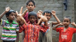 El extraño caso del niño indio con manos gigantes que tiene desconcertados a los médicos