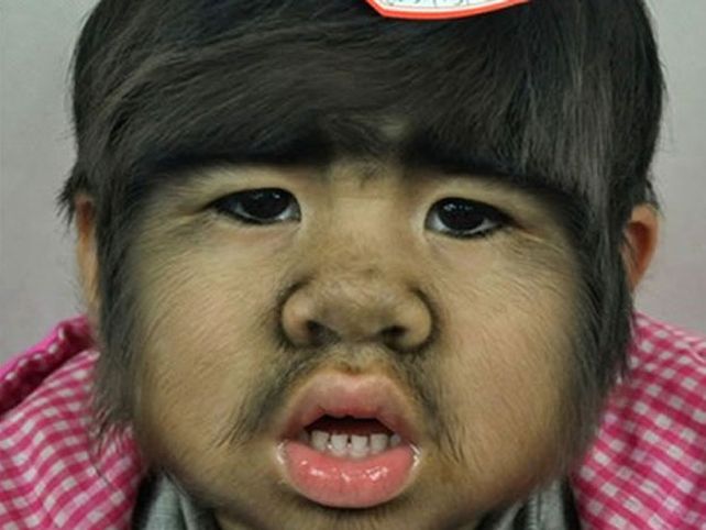 El terrible caso de una niña china de 4 años que sufre el síndrome del hombre lobo
