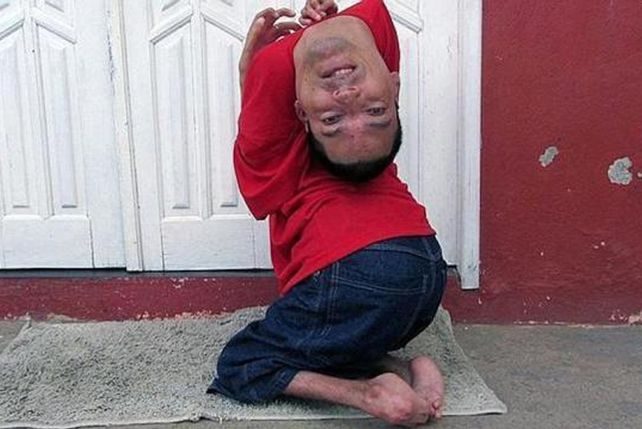 Conocé la historia del hombre que nació con la cabeza al revés