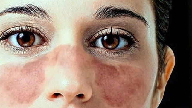 El lupus eritematoso sistémico es una enfermedad crónica autoinmune
