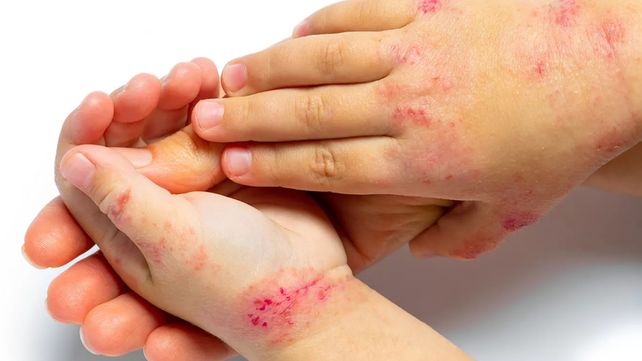 Preocupa la falta de tratamiento inmediato en pacientes con dermatitis atópica
