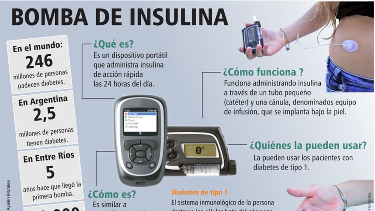 encima intervalo Cortar La bomba de insulina cambia la vida a personas con diabetes