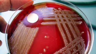 Salud advirtió que la bacteria estreptococo pyogenes es infrecuente