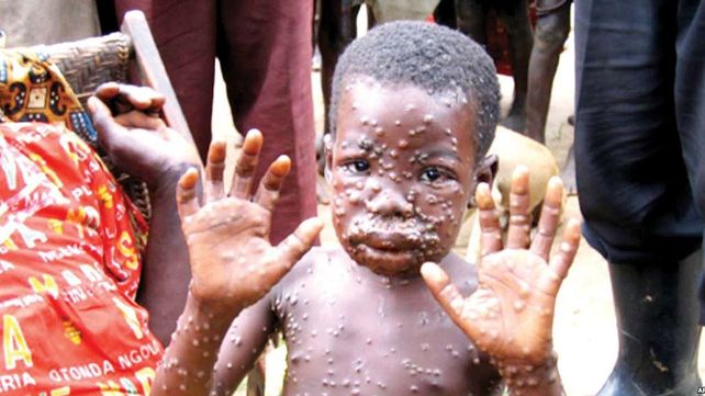 Un niño africano muestra el exantema característico de la enfermedad distribuido por todo su cuerpo.