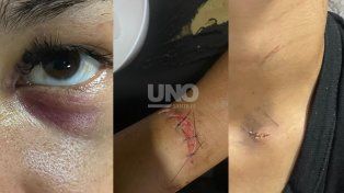 Bestial relato: “Me rompió la botella en la cabeza, cuando me quiero defender ella estaba con el pico de la botella. Directamente ella me quería matar porque me quería cortar el cuello”